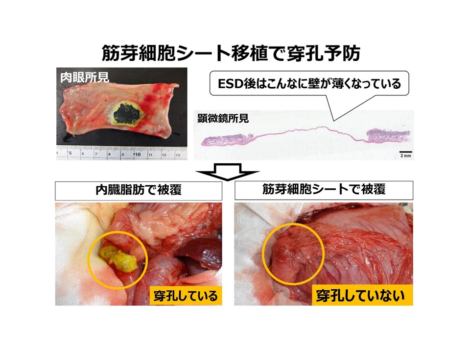 筋芽細胞シート移植